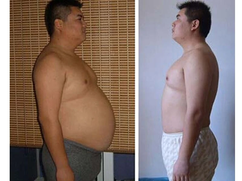 Abdomen fat freezing 1.jpg