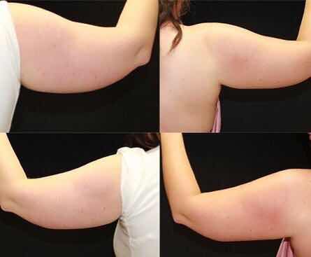 Arm fat freezing 2.jpg