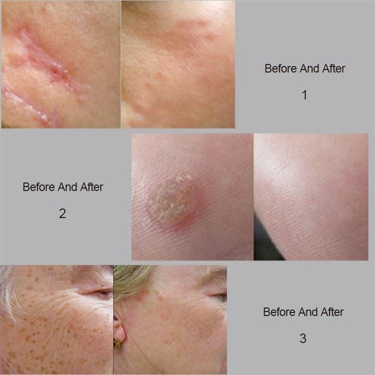 CO2 Laser Machine For Scar Removal